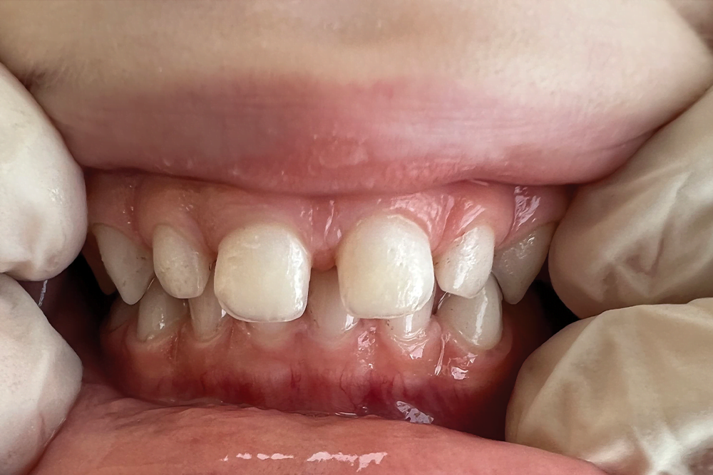 After treatment