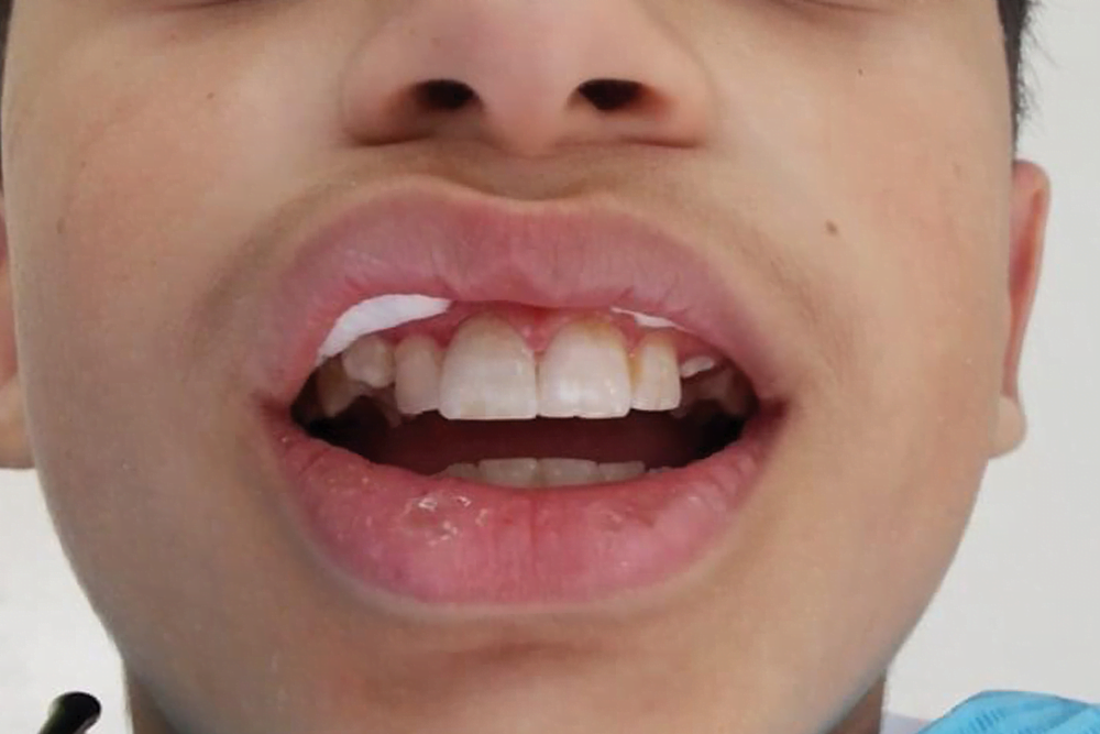 After treatment