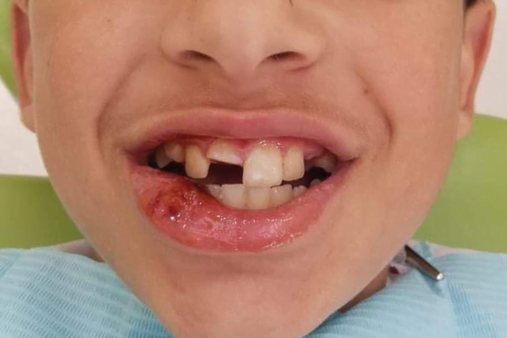 Before treatment