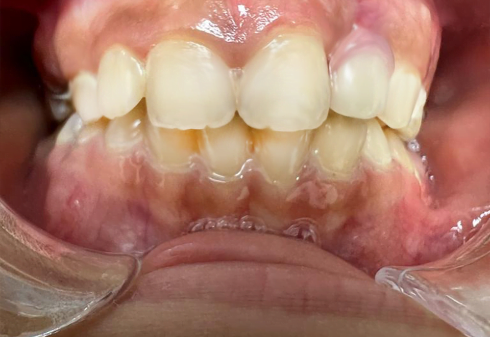 After treatment