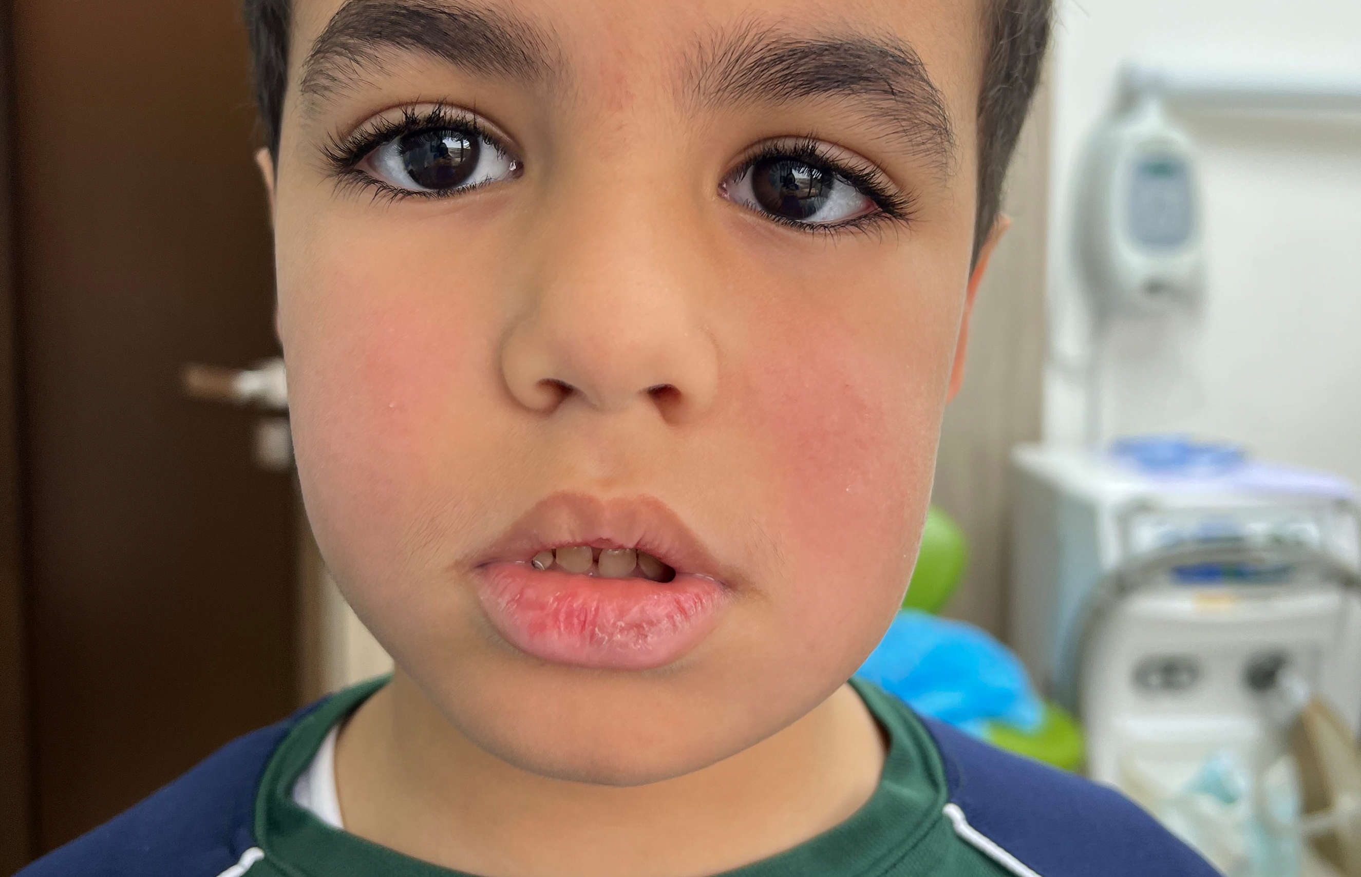 Before treatment