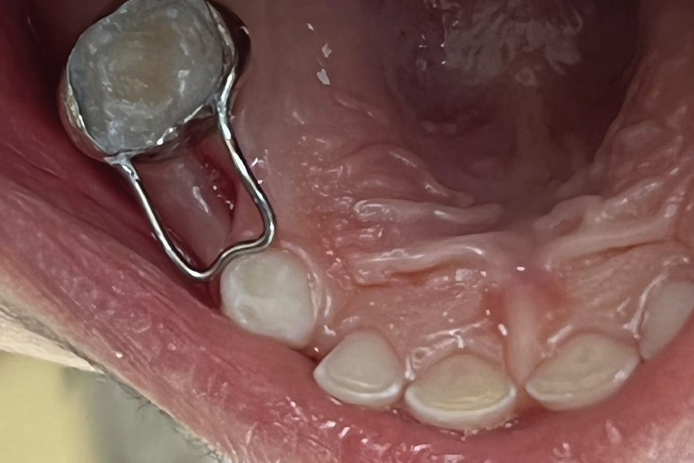 Before treatment