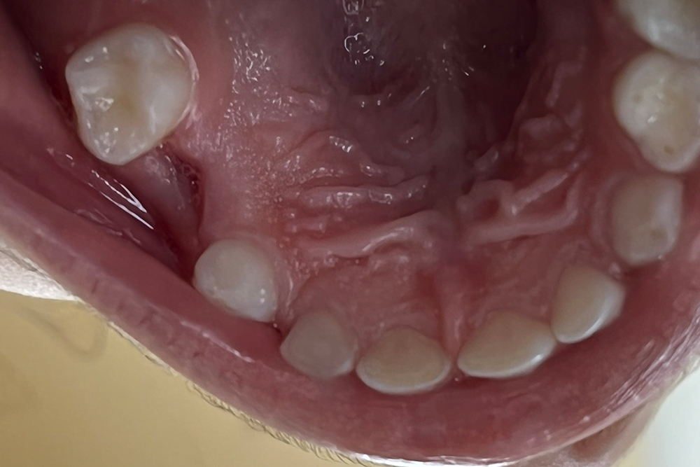 After treatment