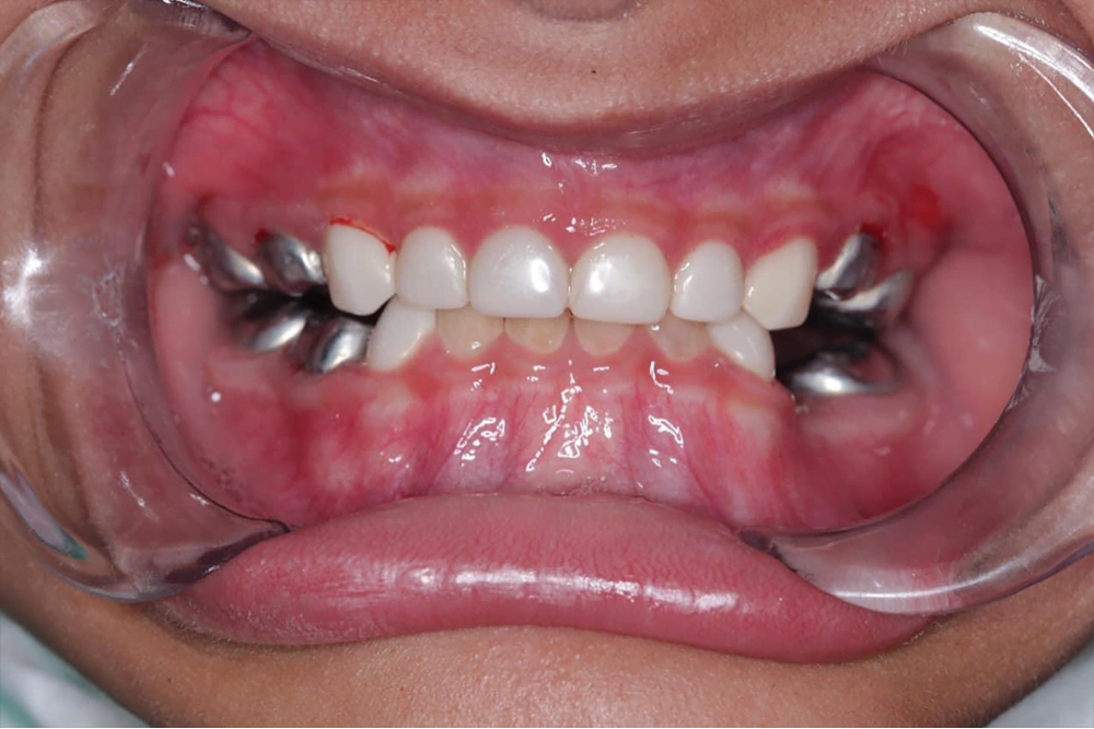 After treatment