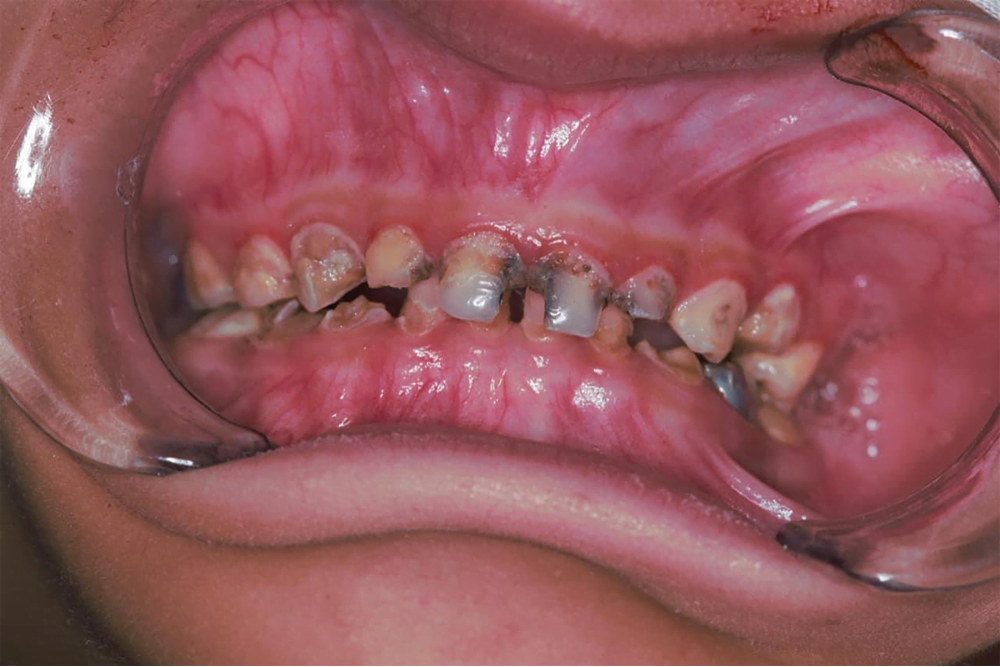 Before treatment
