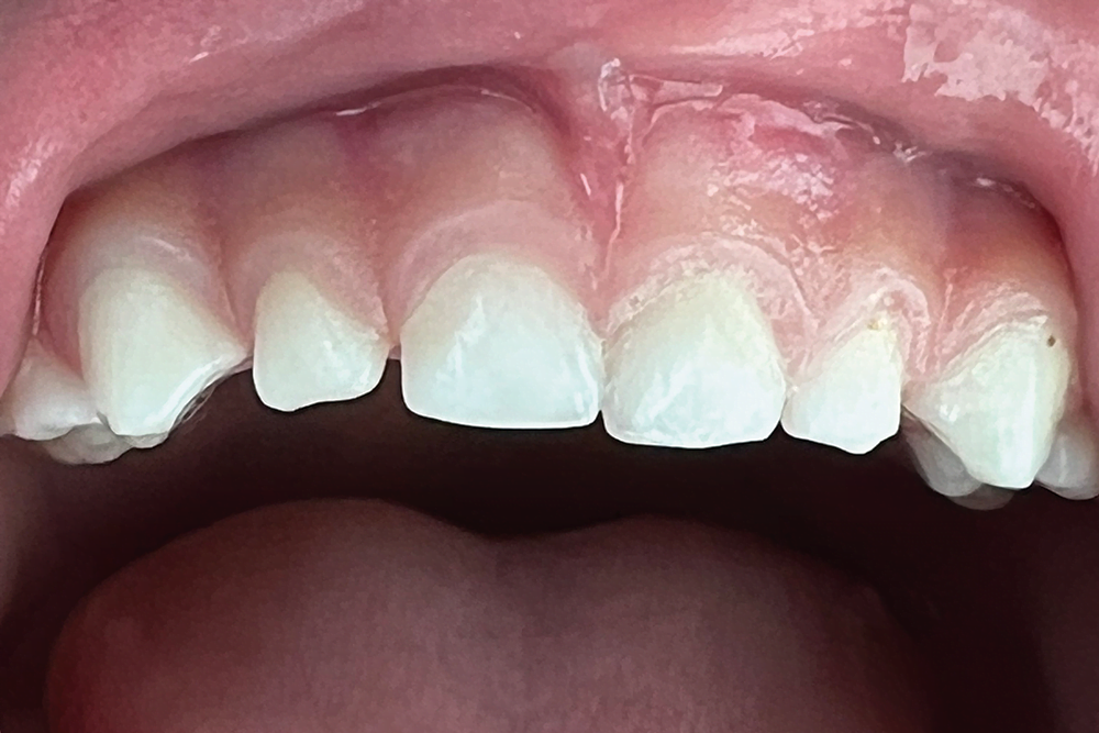 After treatment