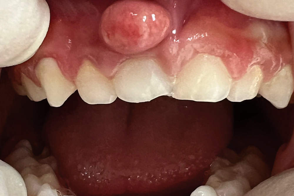 Before treatment