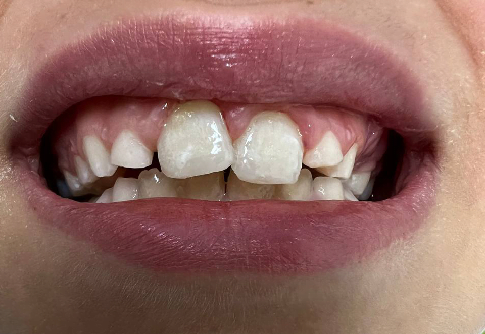 After treatment